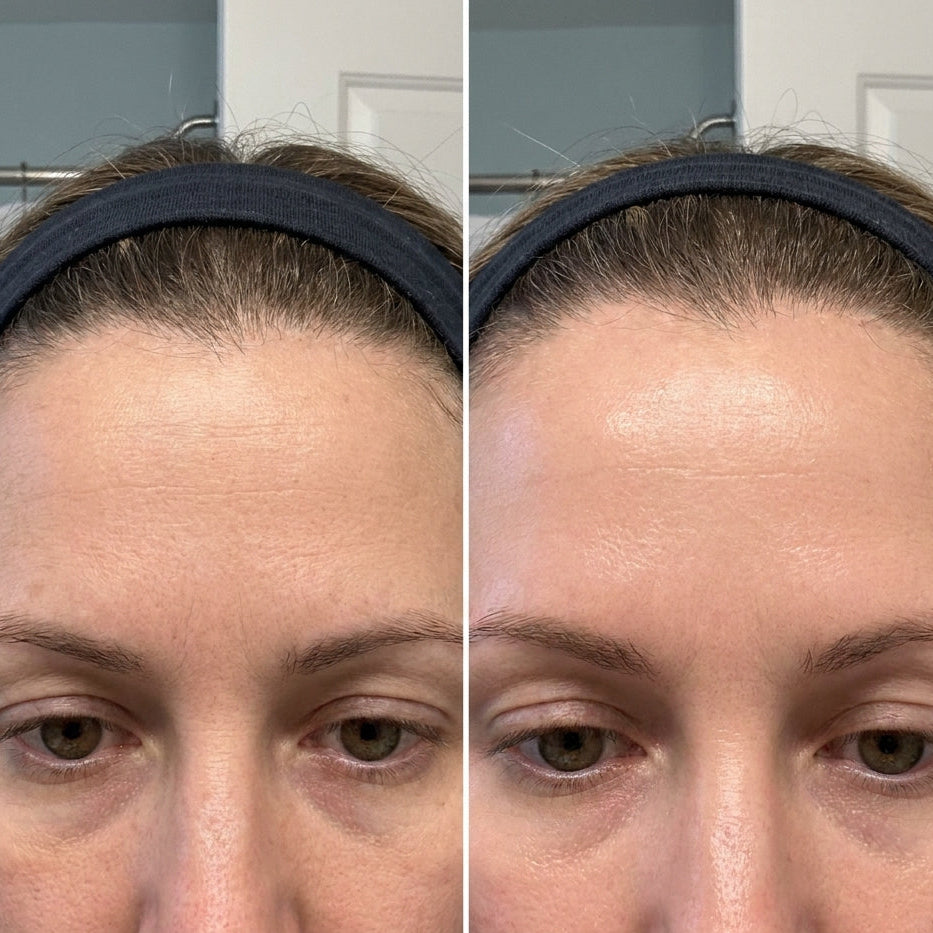 Before and after — forehead lines
